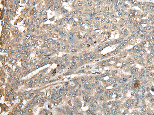 Immunohistochemistry of paraffin-embedded Human liver cancer tissue using ATXN3 Polyclonal Antibody at dilution of 1:100(×200)
