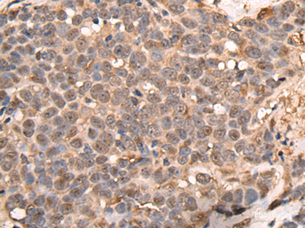 Immunohistochemistry of paraffin-embedded Human thyroid cancer tissue using ATRIP Polyclonal Antibody at dilution of 1:40(×200)