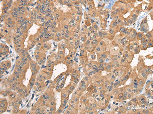 Immunohistochemistry of paraffin-embedded Human thyroid cancer tissue using BCAN Polyclonal Antibody at dilution of 1:35(×200)