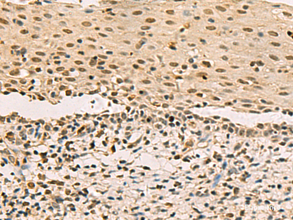 Immunohistochemistry of paraffin-embedded Human cervical cancer tissue using LRIF1 Polyclonal Antibody at dilution of 1:70(×200)