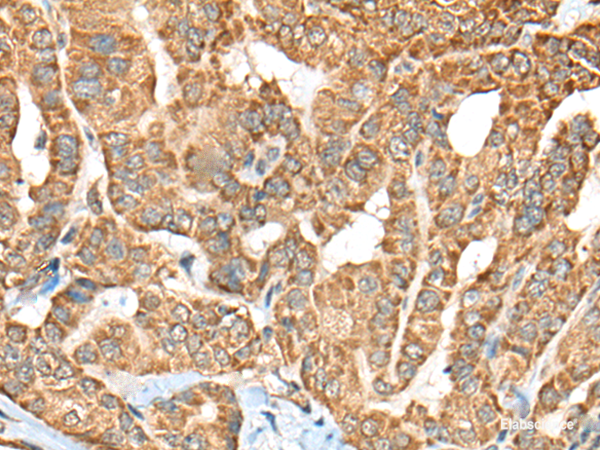 Immunohistochemistry of paraffin-embedded Human thyroid cancer tissue using C1R Polyclonal Antibody at dilution of 1:70(×200)