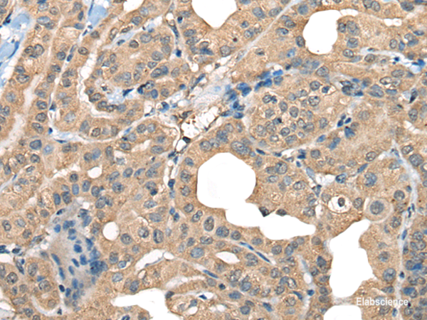 Immunohistochemistry of paraffin-embedded Human thyroid cancer tissue using CABP5 Polyclonal Antibody at dilution of 1:65(×200)