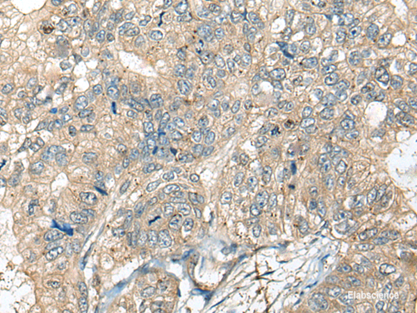 Immunohistochemistry of paraffin-embedded Human gastric cancer tissue using CASR Polyclonal Antibody at dilution of 1:60(×200)