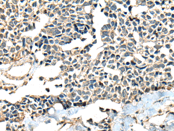Immunohistochemistry of paraffin-embedded Human lung cancer tissue using CALHM1 Polyclonal Antibody at dilution of 1:60(×200)