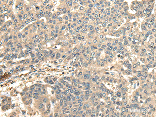 Immunohistochemistry of paraffin-embedded Human liver cancer tissue using CCDC113 Polyclonal Antibody at dilution of 1:65(×200)
