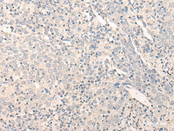 Immunohistochemistry of paraffin-embedded Human cervical cancer tissue using RADIL Polyclonal Antibody at dilution of 1:40(×200)