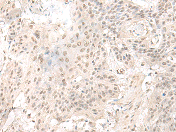 Immunohistochemistry of paraffin-embedded Human esophagus cancer tissue using ILKAP Polyclonal Antibody at dilution of 1:50(×200)