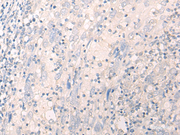 Immunohistochemistry of paraffin-embedded Human cervical cancer tissue using LILRA2 Polyclonal Antibody at dilution of 1:40(×200)