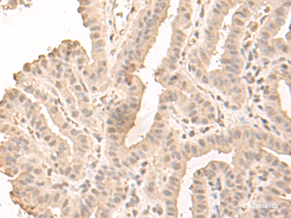 Immunohistochemistry of paraffin-embedded Human thyroid cancer tissue using SAP130 Polyclonal Antibody at dilution of 1:50(×200)