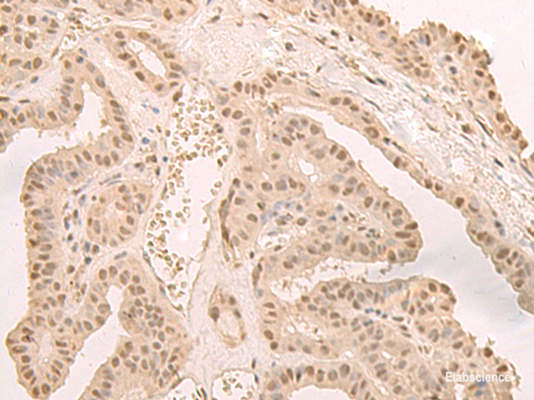 Immunohistochemistry of paraffin-embedded Human thyroid cancer tissue using CNOT10 Polyclonal Antibody at dilution of 1:50(×200)