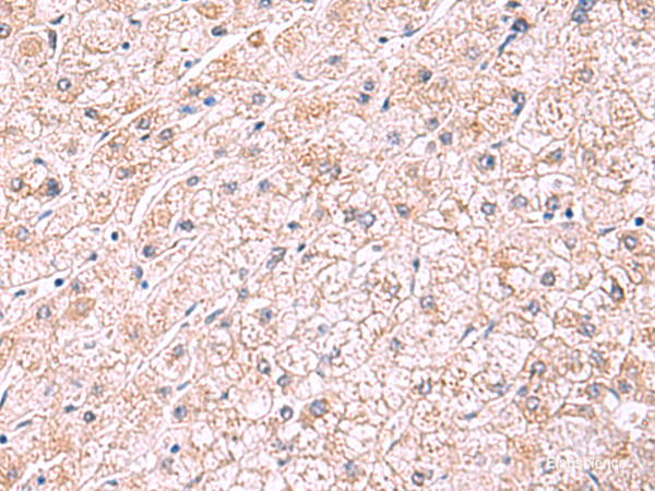 Immunohistochemistry of paraffin-embedded Human liver cancer tissue using PDRG1 Polyclonal Antibody at dilution of 1:75(×200)