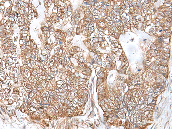 Immunohistochemistry of paraffin-embedded Human gastric cancer tissue using RNF111 Polyclonal Antibody at dilution of 1:50(×200)