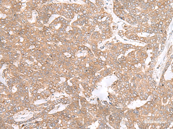 Immunohistochemistry of paraffin-embedded Human liver cancer tissue using PTP4A3 Polyclonal Antibody at dilution of 1:40(×200)