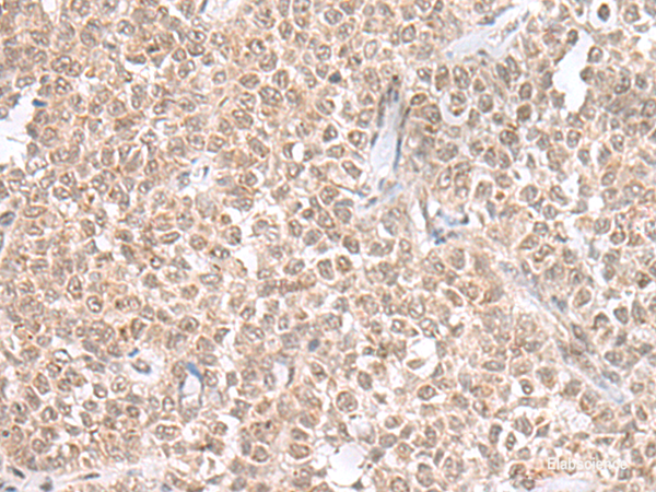 Immunohistochemistry of paraffin-embedded Human ovarian cancer tissue using THAP12 Polyclonal Antibody at dilution of 1:45(×200)