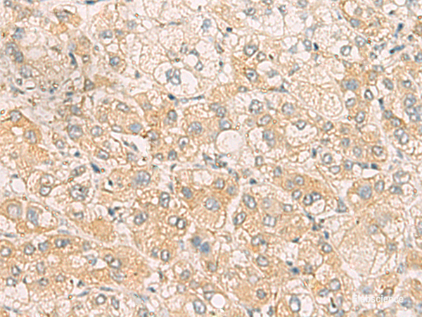 Immunohistochemistry of paraffin-embedded Human liver cancer tissue using SYNGR1 Polyclonal Antibody at dilution of 1:60(×200)