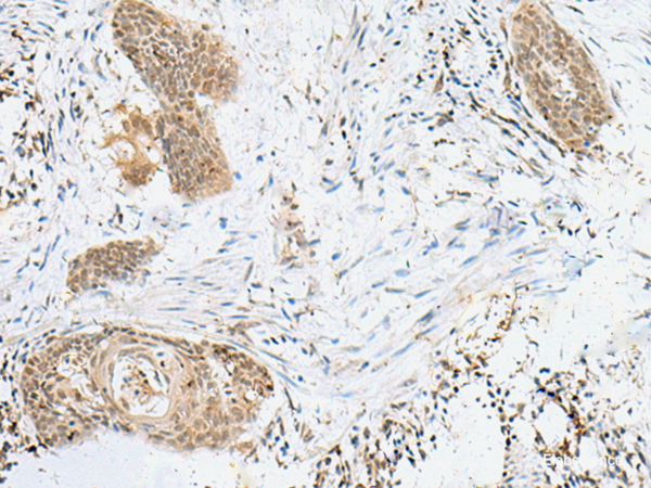 Immunohistochemistry of paraffin-embedded Human esophagus cancer tissue using LPXN Polyclonal Antibody at dilution of 1:60(×200)