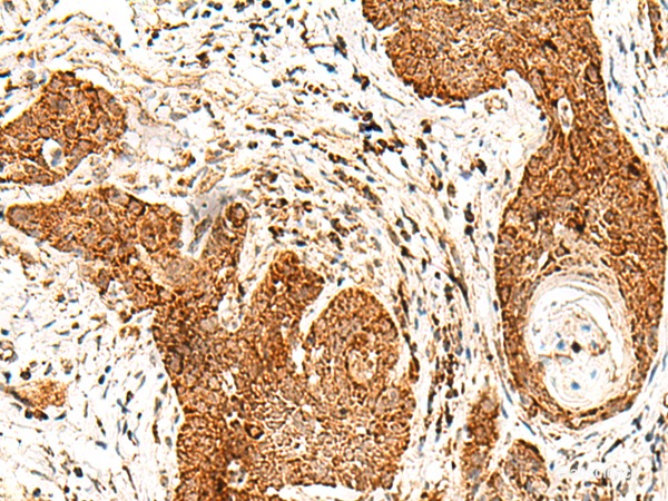 Immunohistochemistry of paraffin-embedded Human esophagus cancer tissue using SMOC1 Polyclonal Antibody at dilution of 1:50(×200)