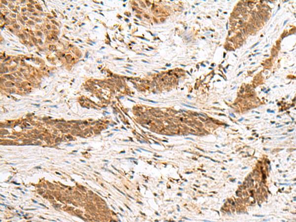 Immunohistochemistry of paraffin-embedded Human esophagus cancer tissue using NUP58 Polyclonal Antibody at dilution of 1:50(×200)