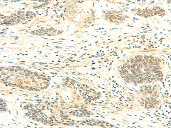 Immunohistochemistry of paraffin-embedded Human esophagus cancer tissue using ATMIN Polyclonal Antibody at dilution of 1:50(×200)