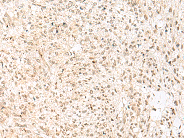 Immunohistochemistry of paraffin-embedded Human liver cancer tissue using RBX1 Polyclonal Antibody at dilution of 1:50(×200)