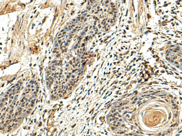 Immunohistochemistry of paraffin-embedded Human esophagus cancer tissue using NUTF2 Polyclonal Antibody at dilution of 1:110(×200)