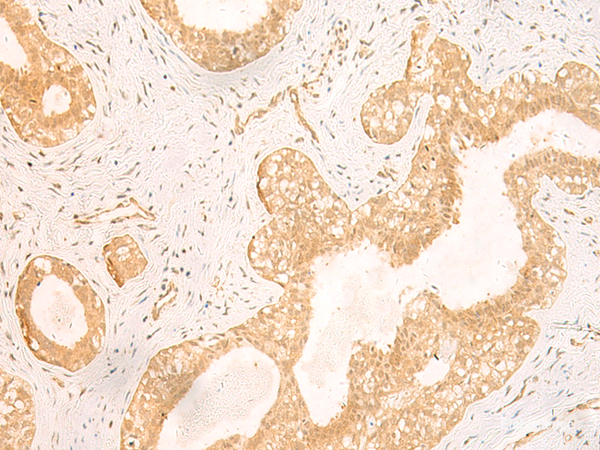 Immunohistochemistry of paraffin-embedded Human breast cancer tissue using GSG1L Polyclonal Antibody at dilution of 1:50(×200)