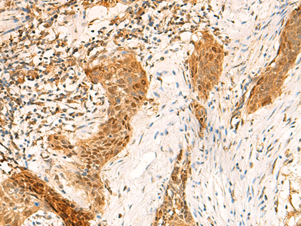 Immunohistochemistry of paraffin-embedded Human esophagus cancer tissue using GINS2 Polyclonal Antibody at dilution of 1:50(×200)