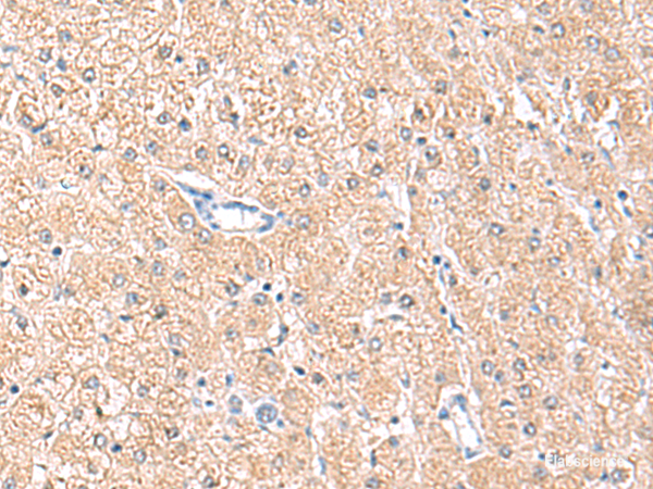 Immunohistochemistry of paraffin-embedded Human liver cancer tissue using MLKL Polyclonal Antibody at dilution of 1:85(×200)