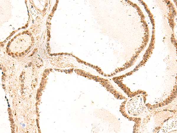 Immunohistochemistry of paraffin-embedded Human thyroid cancer tissue using ZFYVE27 Polyclonal Antibody at dilution of 1:50(×200)