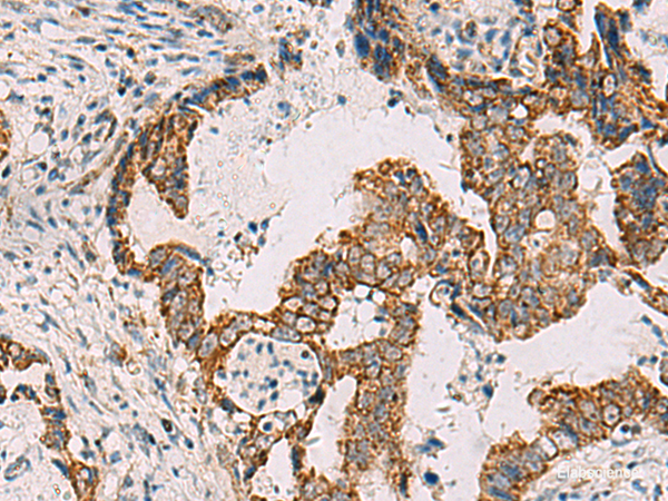 Immunohistochemistry of paraffin-embedded Human cervical cancer tissue using PDHA1 Polyclonal Antibody at dilution of 1:50(×200)