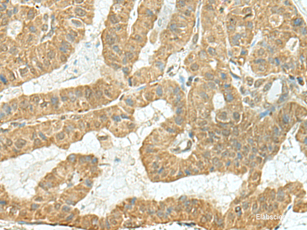 Immunohistochemistry of paraffin-embedded Human thyroid cancer tissue using TENT5C Polyclonal Antibody at dilution of 1:110(×200)