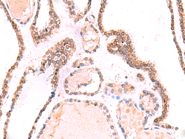 Immunohistochemistry of paraffin-embedded Human thyroid cancer tissue using TOR1AIP1 Polyclonal Antibody at dilution of 1:70(×200)