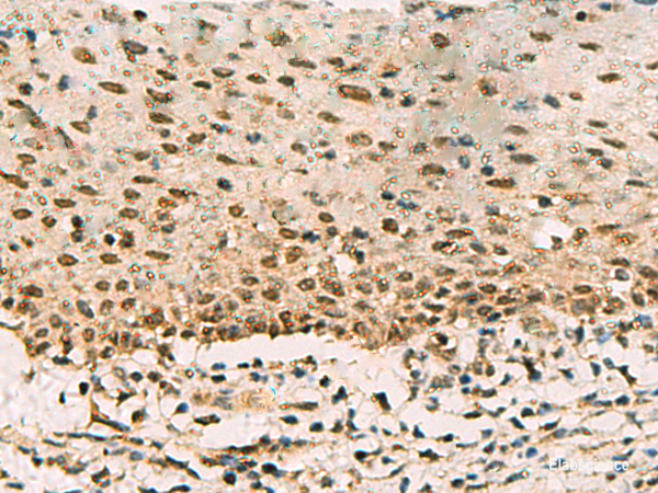 Immunohistochemistry of paraffin-embedded Human cervical cancer tissue using PHF5A Polyclonal Antibody at dilution of 1:90(×200)