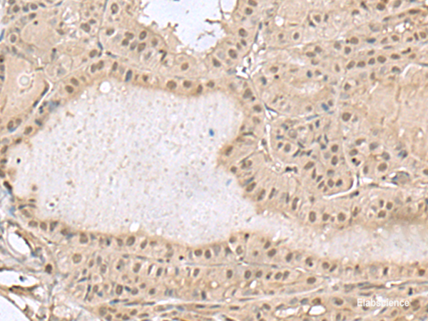 Immunohistochemistry of paraffin-embedded Human thyroid cancer tissue using PCLAF Polyclonal Antibody at dilution of 1:50(×200)