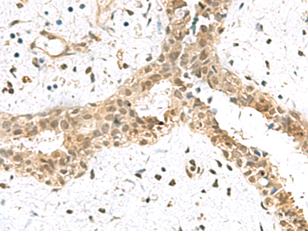 Immunohistochemistry of paraffin-embedded Human breast cancer tissue using ELOC Polyclonal Antibody at dilution of 1:55(×200)