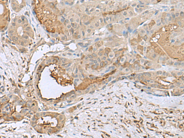 Immunohistochemistry of paraffin-embedded Human thyroid cancer tissue using GABARAPL2 Polyclonal Antibody at dilution of 1:55(×200)