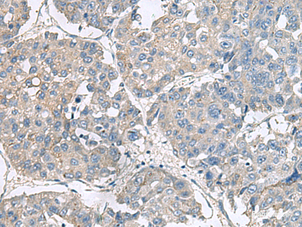 Immunohistochemistry of paraffin-embedded Human liver cancer tissue using NPHP1 Polyclonal Antibody at dilution of 1:75(×200)