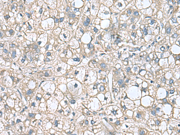 Immunohistochemistry of paraffin-embedded Human liver cancer tissue using RHBDL2 Polyclonal Antibody at dilution of 1:110(×200)