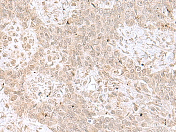 Immunohistochemistry of paraffin-embedded Human ovarian cancer tissue using RPL35 Polyclonal Antibody at dilution of 1:70(×200)