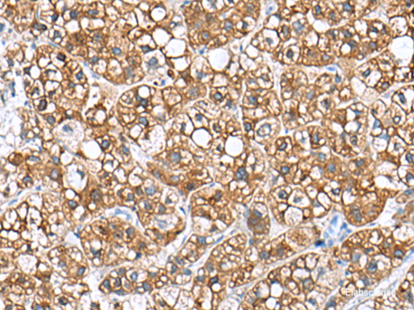 Immunohistochemistry of paraffin-embedded Human liver cancer tissue using PHLDA3 Polyclonal Antibody at dilution of 1:110(×200)