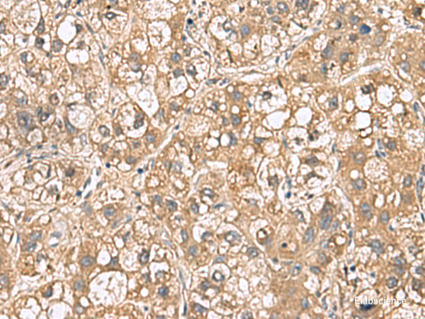 Immunohistochemistry of paraffin-embedded Human liver cancer tissue using PTPRS Polyclonal Antibody at dilution of 1:110(×200)