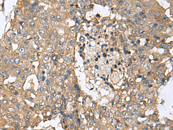 Immunohistochemistry of paraffin-embedded Human liver cancer tissue using CD59 Polyclonal Antibody at dilution of 1:160(×200)
