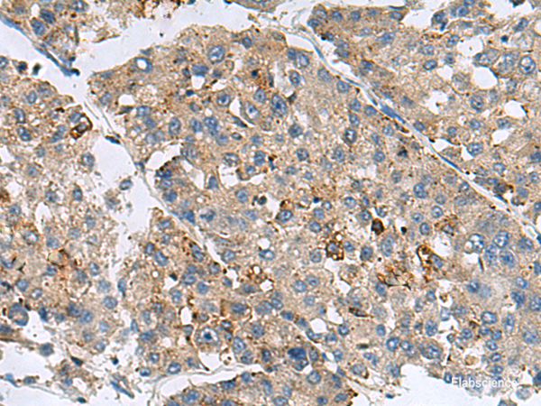 Immunohistochemistry of paraffin-embedded Human liver cancer tissue using MED31 Polyclonal Antibody at dilution of 1:100(×200)