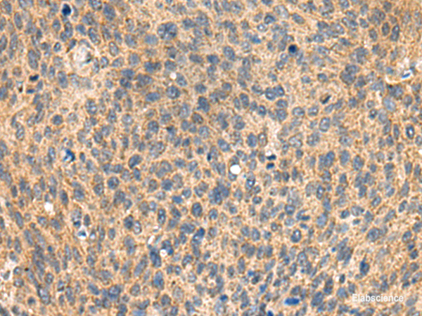 Immunohistochemistry of paraffin-embedded Human cervical cancer tissue using MIA Polyclonal Antibody at dilution of 1:100(×200)
