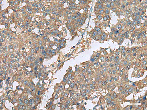 Immunohistochemistry of paraffin-embedded Human liver cancer tissue using EIF1AX Polyclonal Antibody at dilution of 1:65(×200)