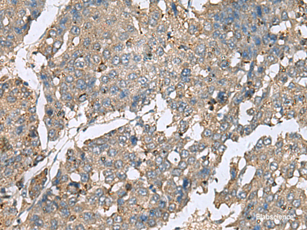 Immunohistochemistry of paraffin-embedded Human liver cancer tissue using PLA2G2A Polyclonal Antibody at dilution of 1:50(×200)