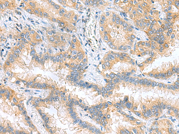 Immunohistochemistry of paraffin-embedded Human lung cancer tissue using RPS16 Polyclonal Antibody at dilution of 1:60(×200)