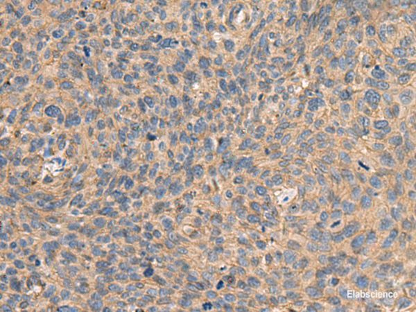 Immunohistochemistry of paraffin-embedded Human cervical cancer tissue using AHNAK Polyclonal Antibody at dilution of 1:50(×200)