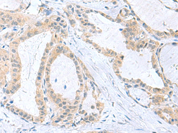 Immunohistochemistry of paraffin-embedded Human thyroid cancer tissue using PDE6D Polyclonal Antibody at dilution of 1:50(×200)