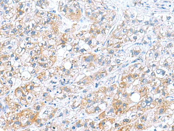 Immunohistochemistry of paraffin-embedded Human liver cancer tissue using DNAL1 Polyclonal Antibody at dilution of 1:70(×200)